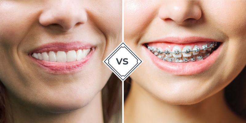 Invisalign versus braces
Fixed braces
Clear aligners