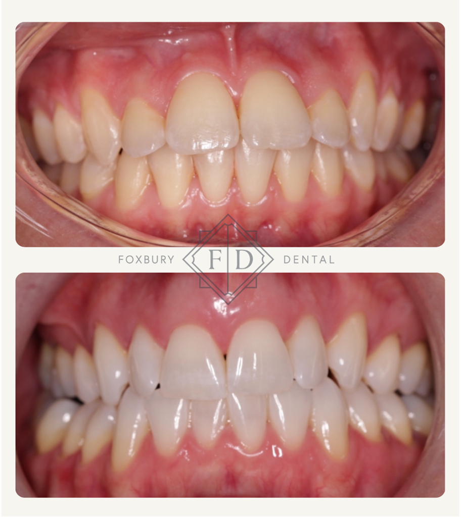 whitening before after 1