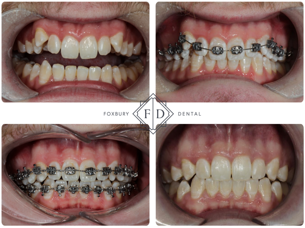Metal Braces before and after 2
