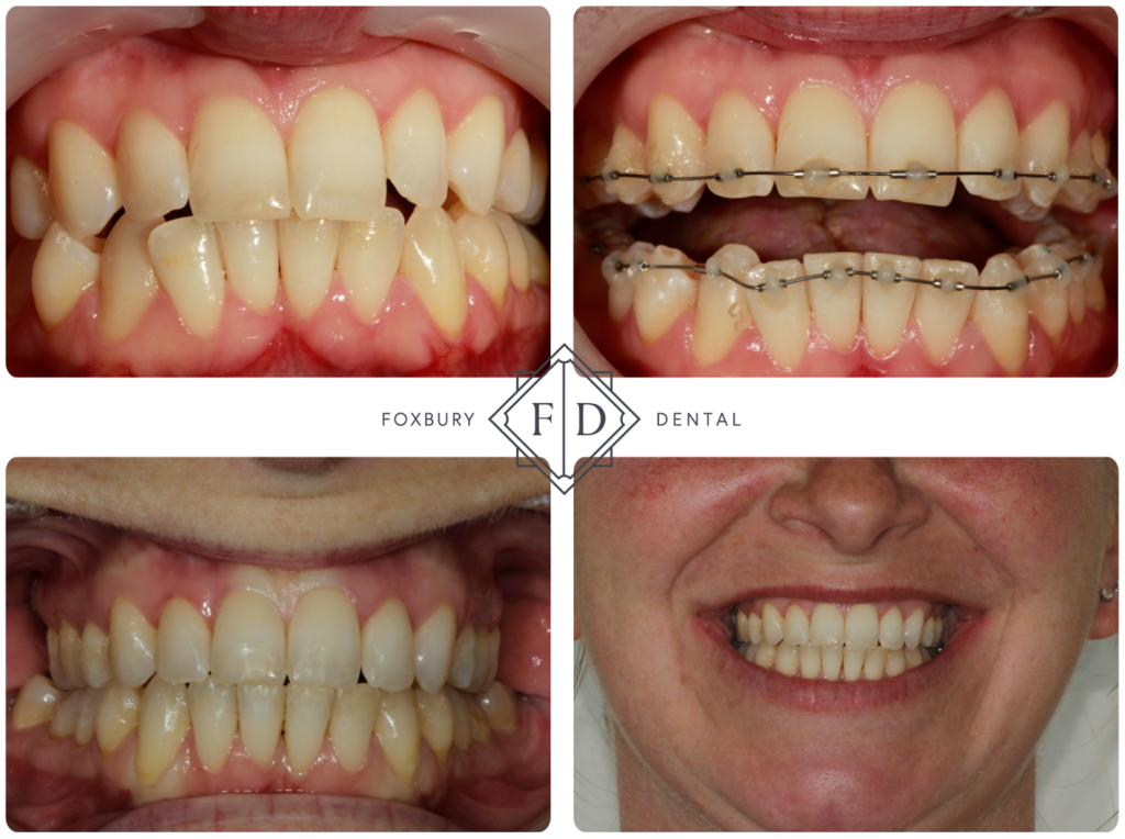 Metal tube braces before after 2