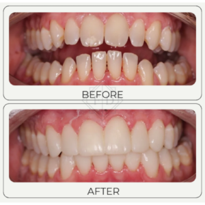 Before after composite bonding