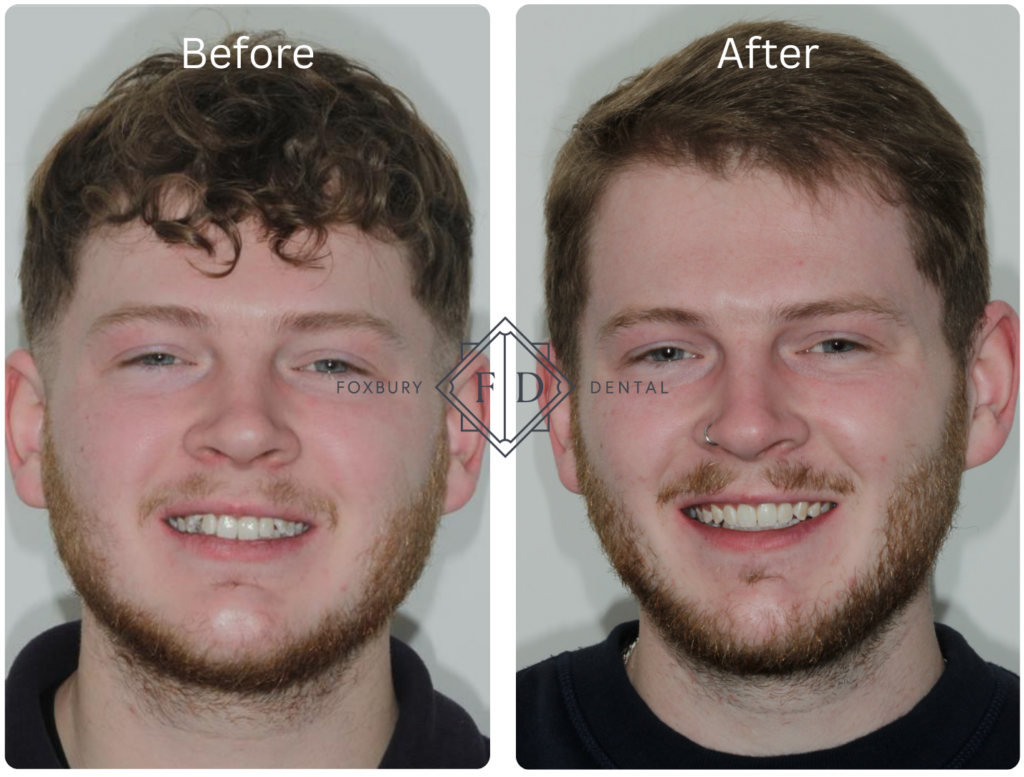 Metal Braces before and after