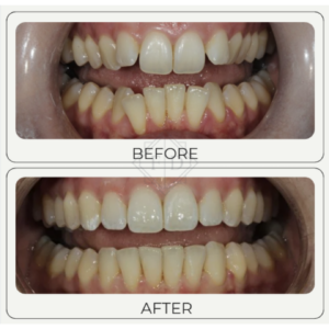 Before after invisalign