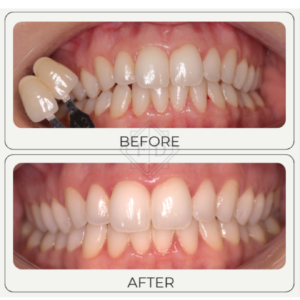 before after whitening