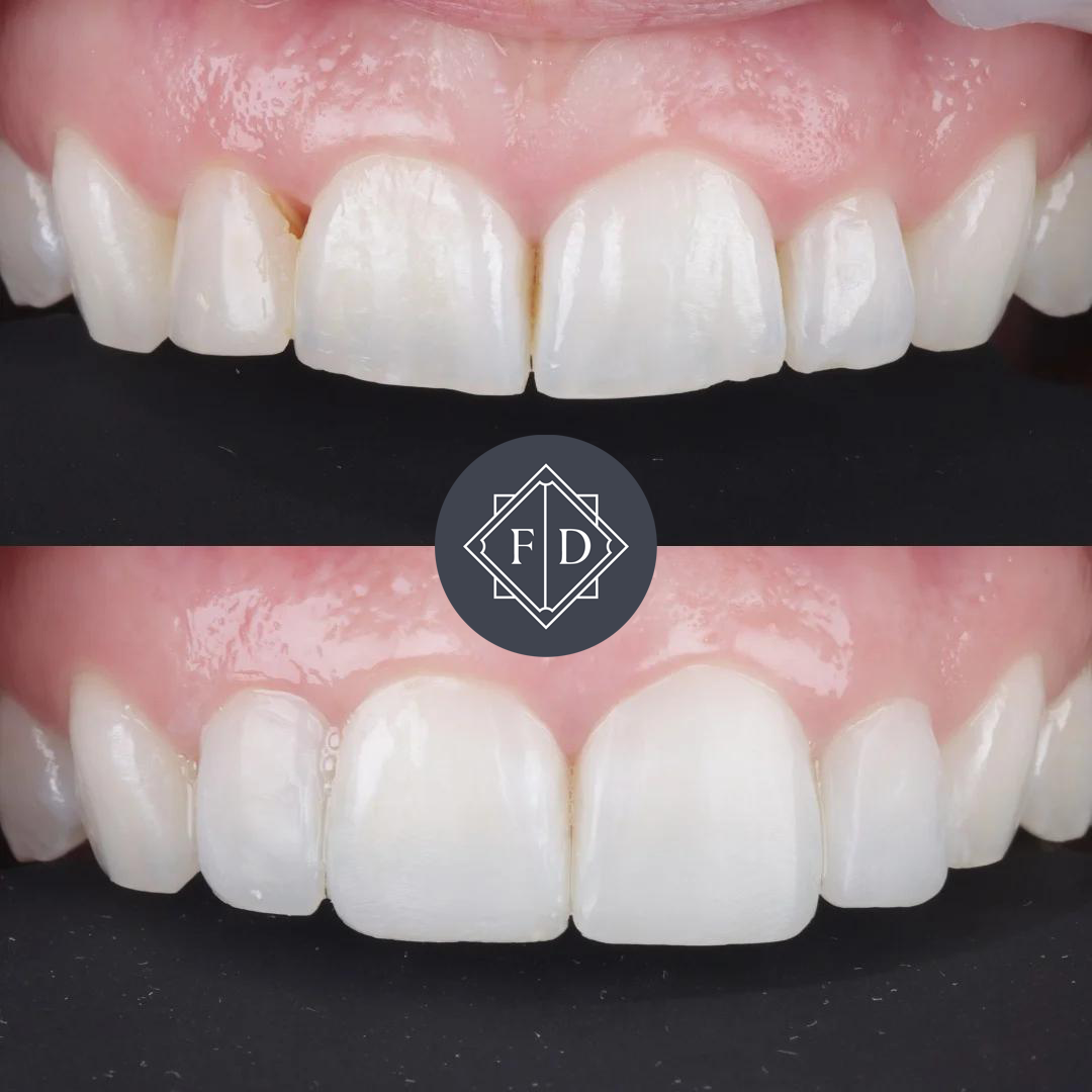 Composite Bonding before After 1