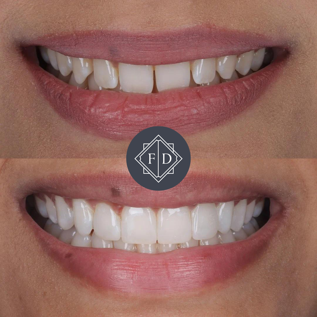 Composite Bonding before After 2