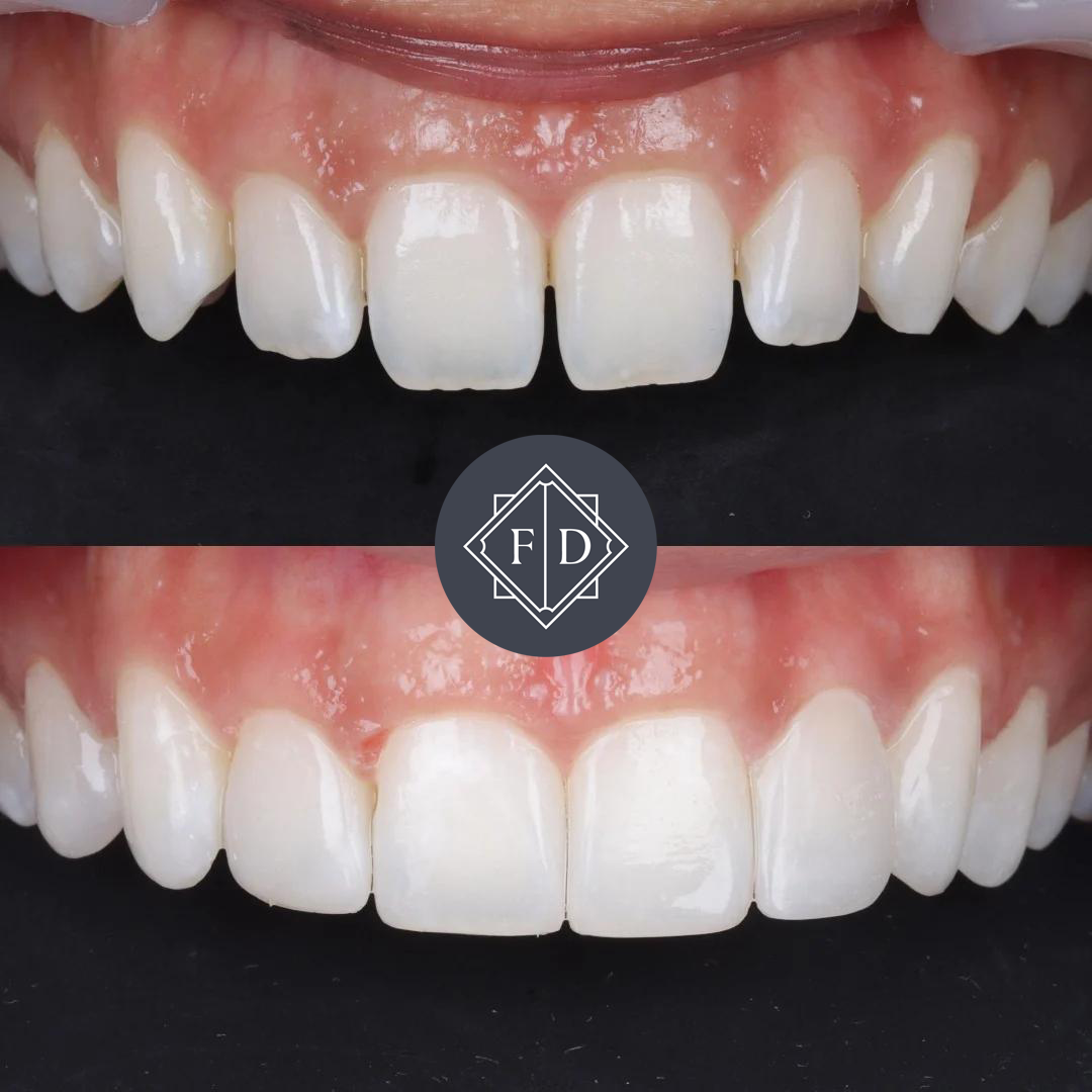 Composite Bonding before After 3