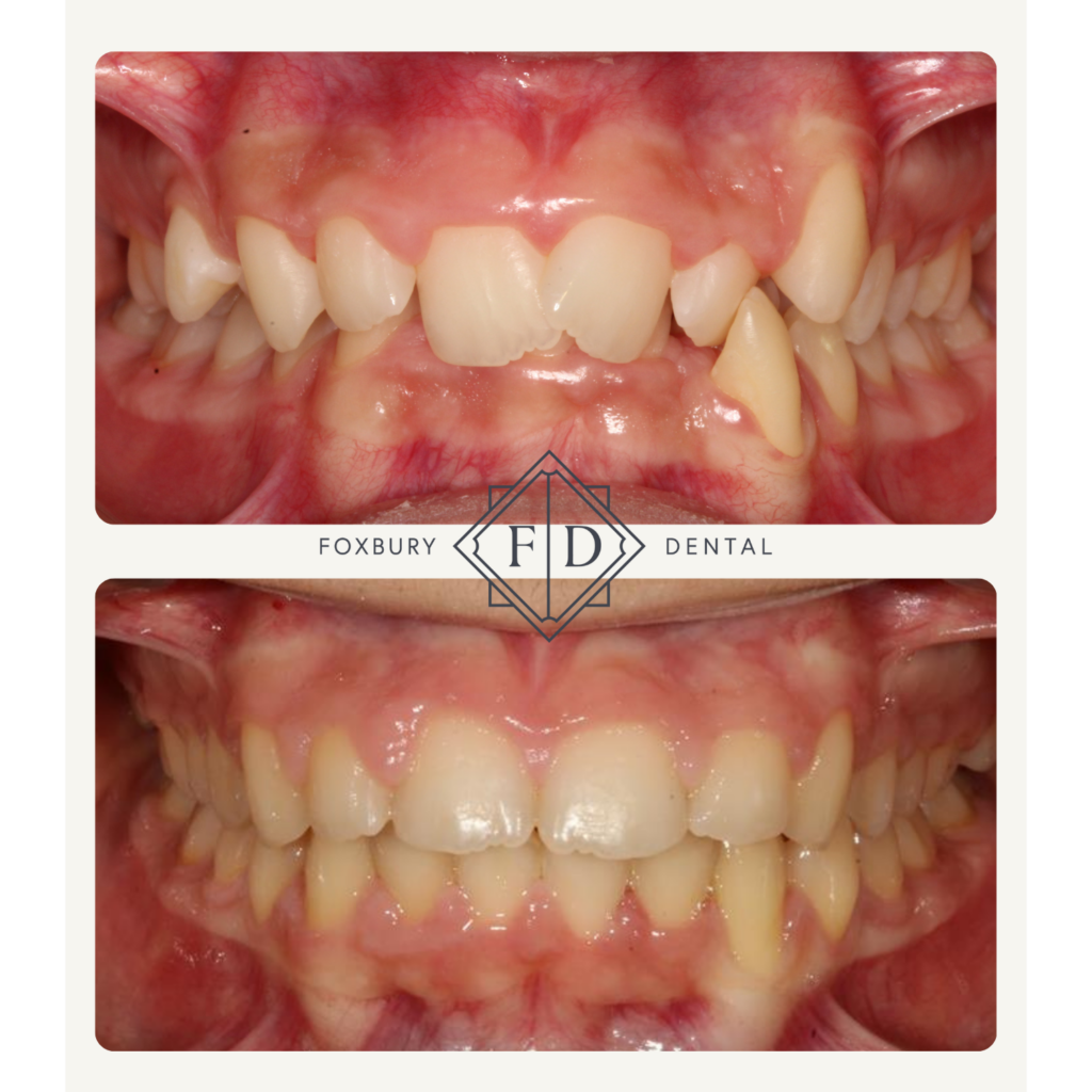 Childrens Braces Before & After 1