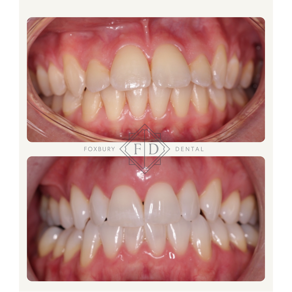 Zoom Whitening - Real Patient Results 1
