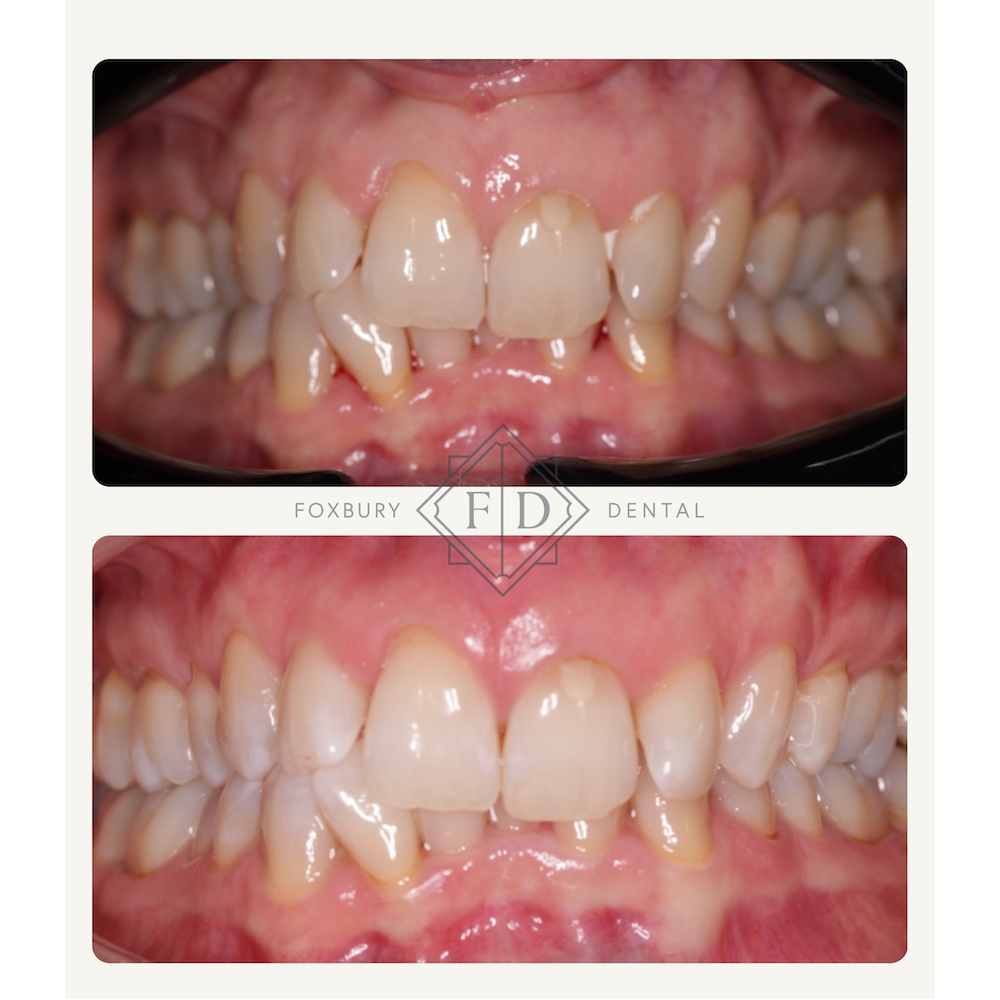 Zoom Whitening - Real Patient Results 2