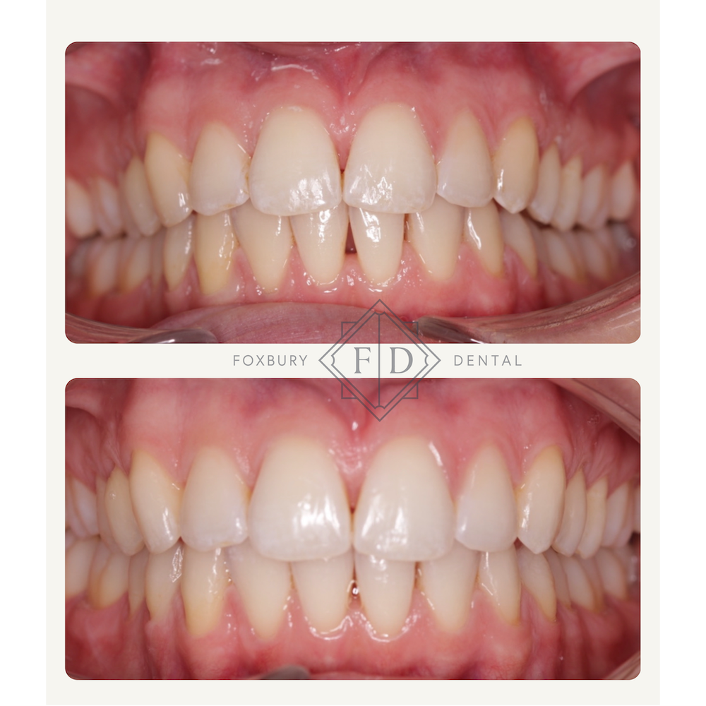 Zoom Whitening - Real Patient Results 3