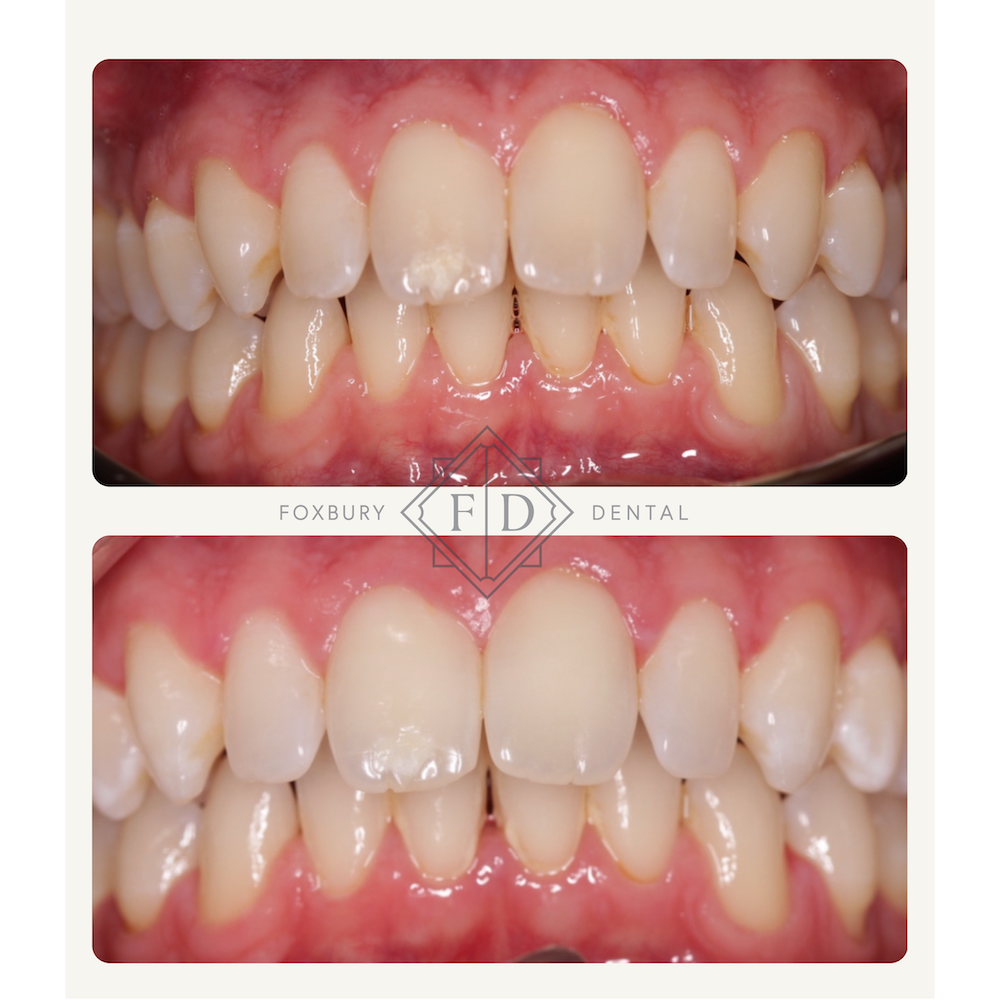 Zoom Whitening - Real Patient Results 4