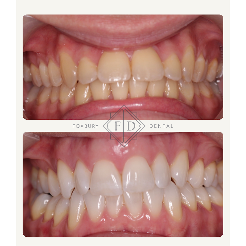 Zoom Whitening - Real Patient Results 5