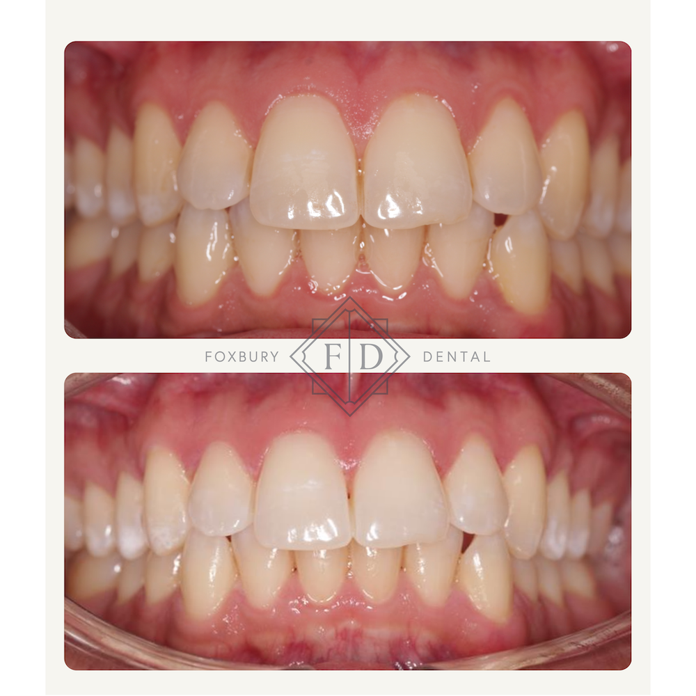 Zoom Whitening - Real Patient Results 6