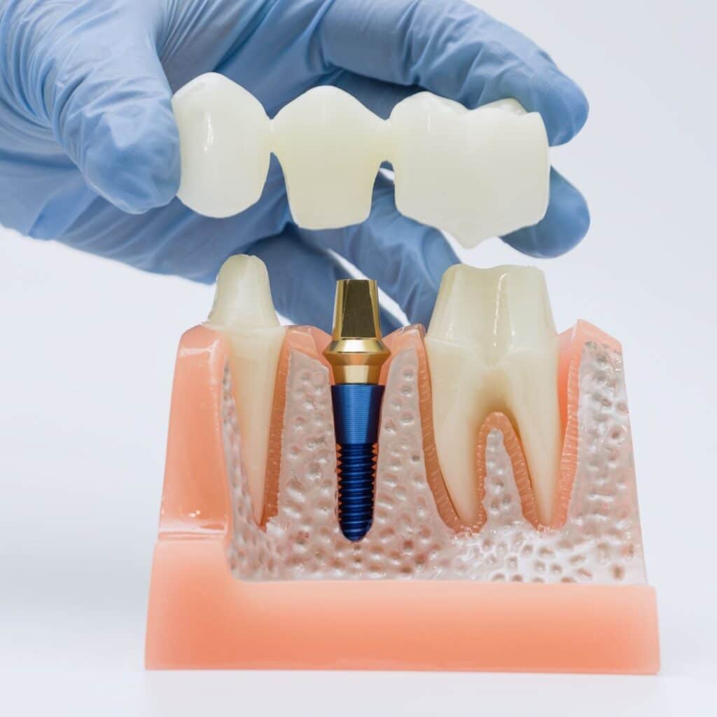 This guide explains what dental bridges are, the main types available, and how long they typically last with good care. It outlines realistic private costs in the UK, what to expect at each appointment at Foxbury Dental, and how comfortable treatment usually is. You will also learn key aftercare tips and how bridges compare with single-tooth dental implants so you can choose confidently.